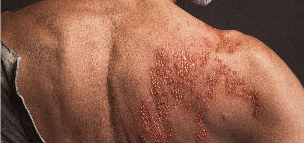 rash